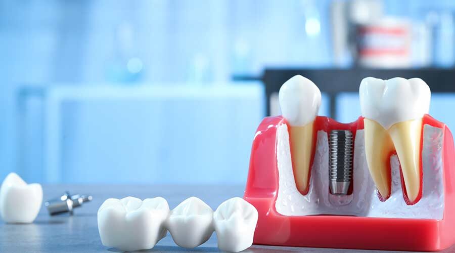 Especialidad en Rehabilitación Oral y Prótesis Implanto asistida